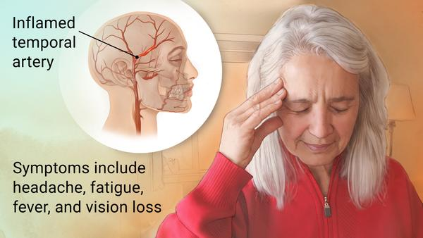 Giant Cell arteritis and stroke