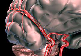 Mechanical thrombectomy techniques Tips & Tricks and Difficult Approaches