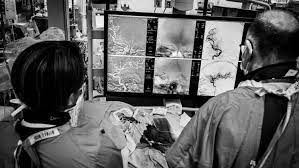 Embolization of Sub-Dural Hematomas