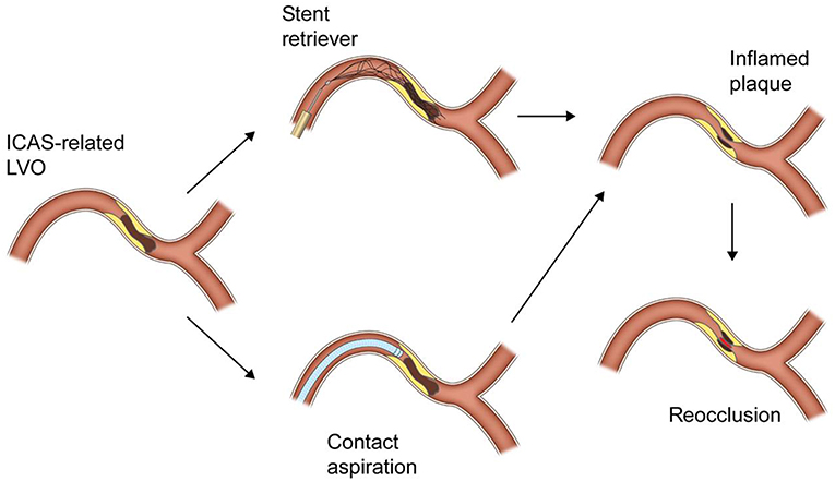 Intracranial atherosclerotic disease (ICAD) Management and treatment