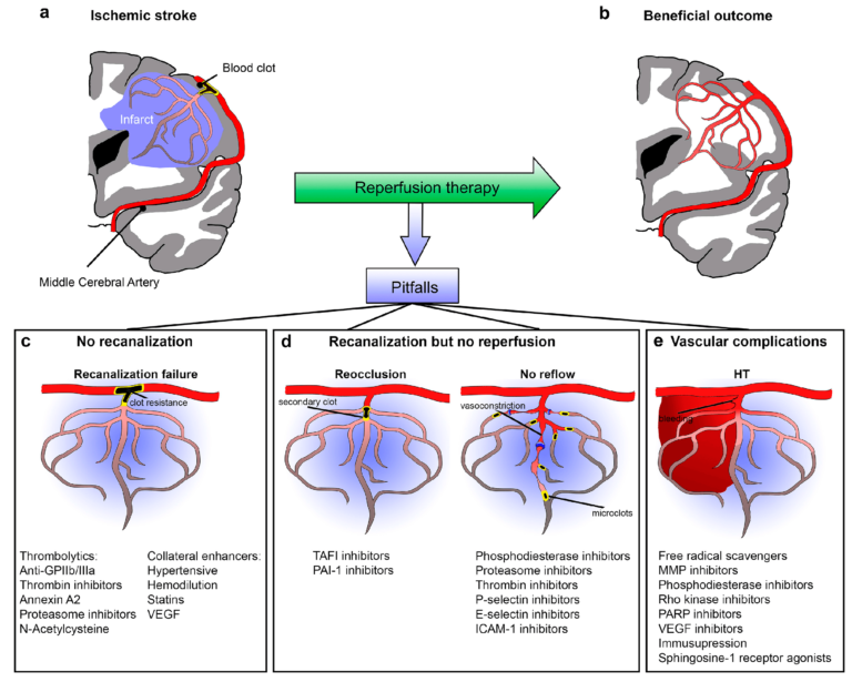 Stroke Imaging How to Predict futile recanalization