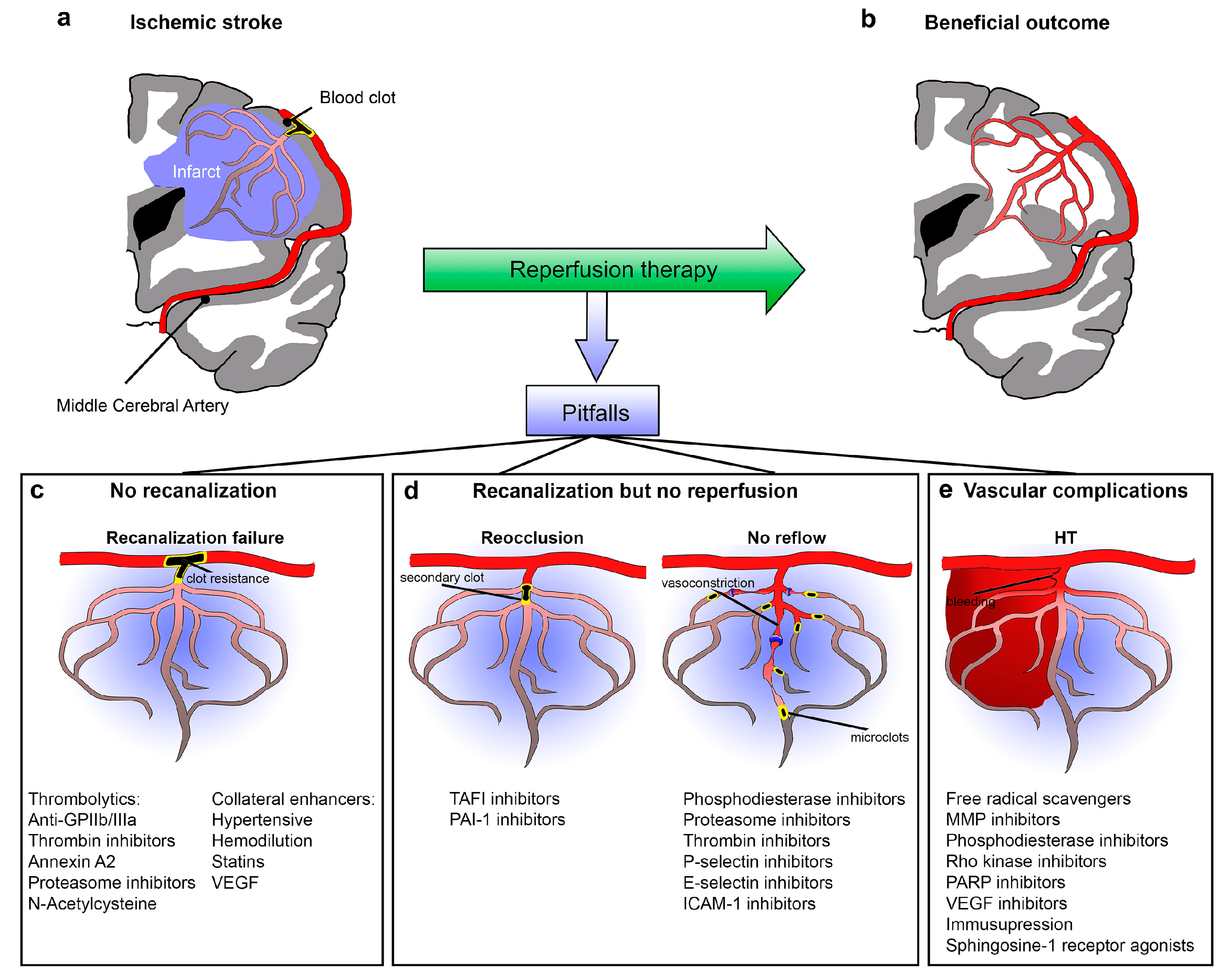 Stroke Imaging How to Predict futile recanalization