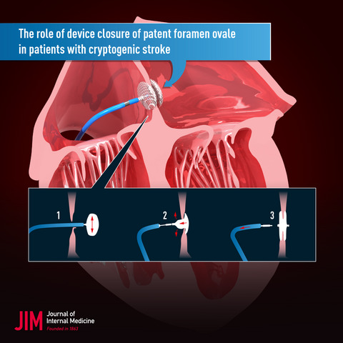 Stroke related to PFO: Patient selection and treatment