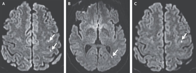 Transient Ischaemic Attack (TIA)