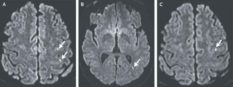 Transient Ischaemic Attack (TIA)